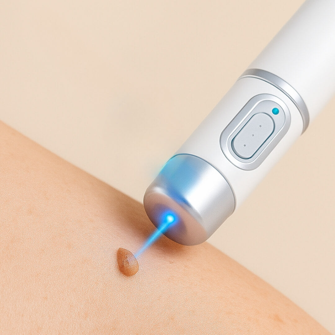 Kidsneed® - Mole and Wart Removal Laser Pen 31 Kidsneed skin tag